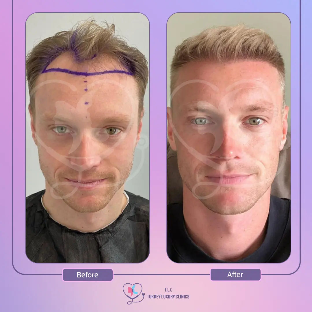زراعة الشعر للرجال في تركيا: التقنيات والنتائج مع التكلفة