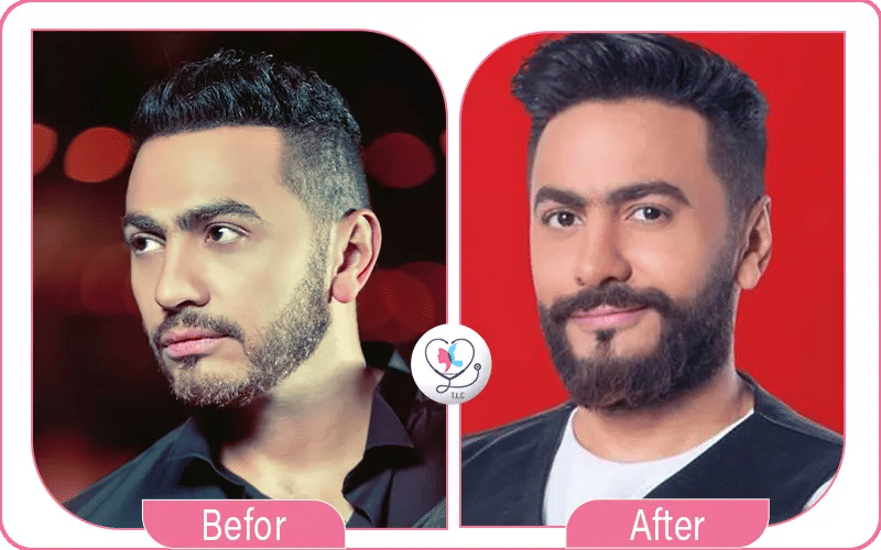 صور تامر حسني قبل وبعد التجميل