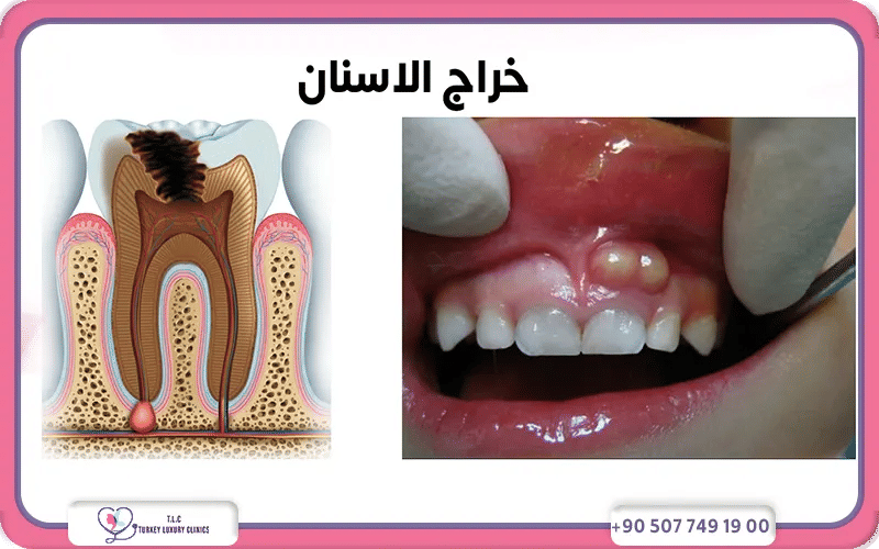 خراج الأسنان بالصور