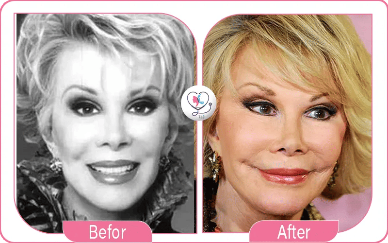 chirurgie plastique ratée photos-2