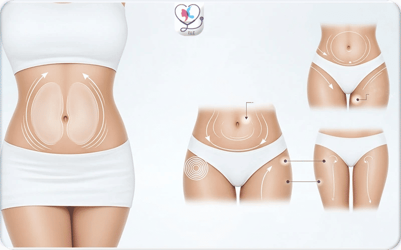 Liposculpture de la silhouette