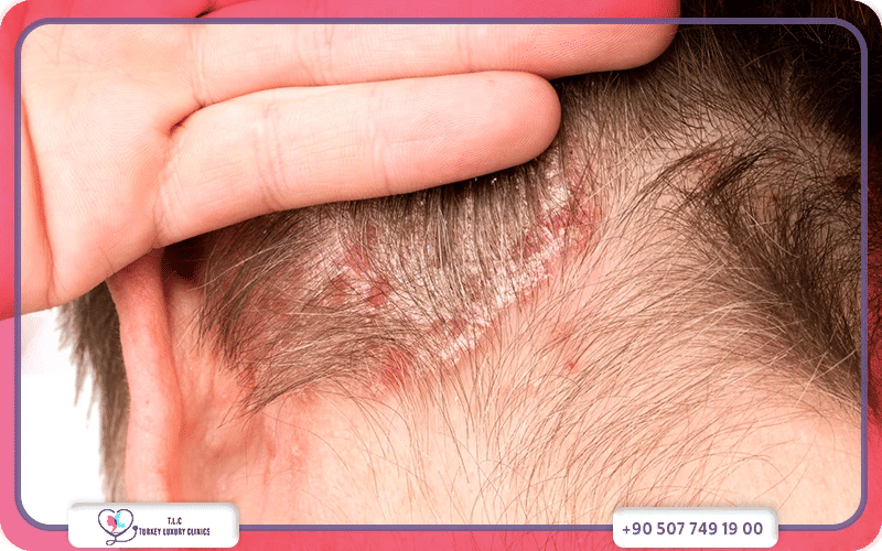 كيف يتم تشخيص صدفية الرأس؟