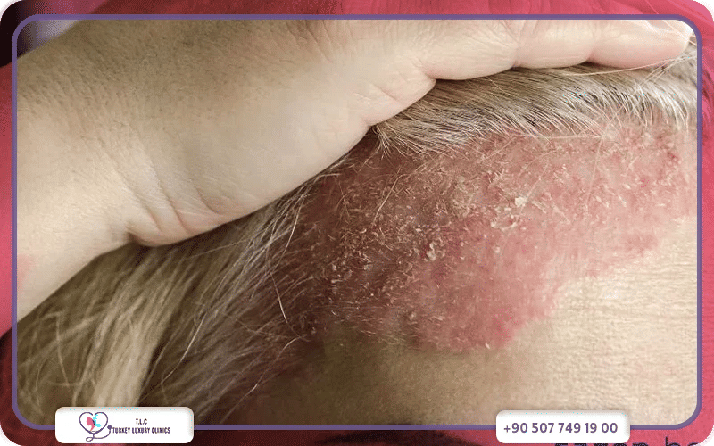 ما هي صدفية الشعر؟