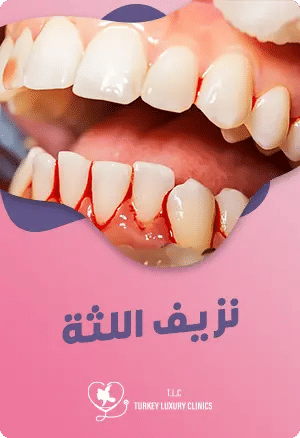 نزيف اللثة: ما هي أسبابه وطرق فعالة لإيقافه والحفاظ على لثة صحية؟featured image