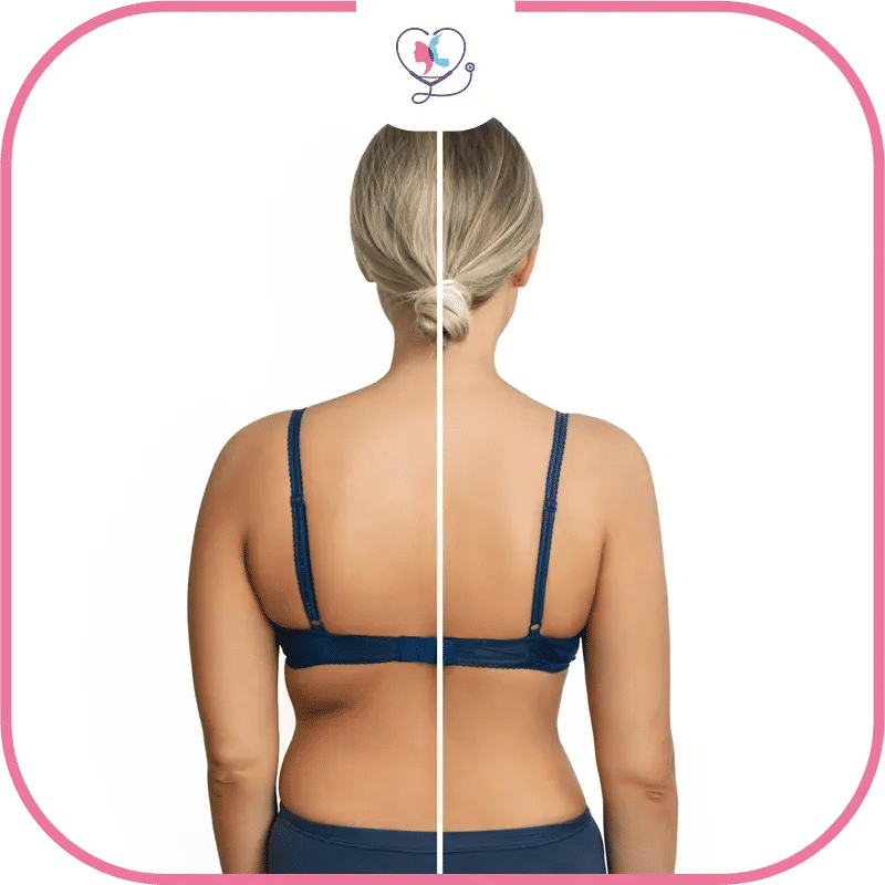 شفط دهون الظهر