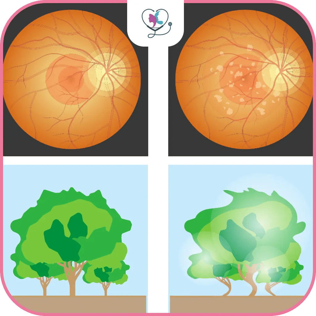 ما هو اعتلال الشبكية السكري؟