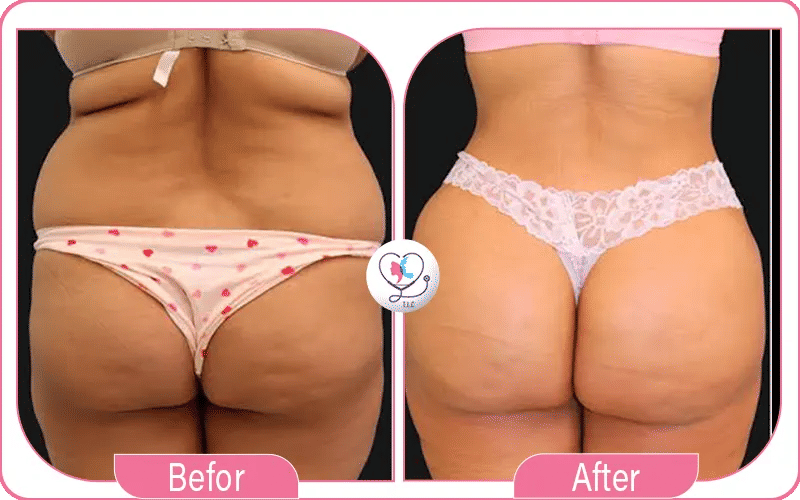 Lipo 360 + BBL Recovery