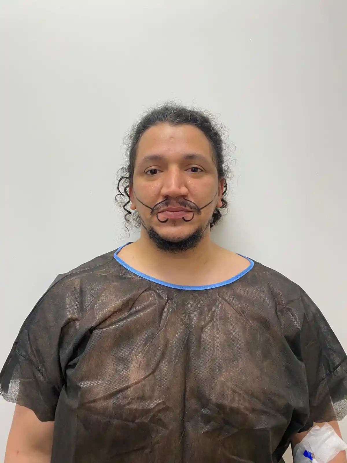 ماهي تكلفة زراعة اللحية في تركيا؟