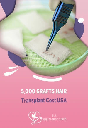 Трансплантация волос 5000 трансплантатов: стоимость в США и сравнение с Турцией 2026featured image