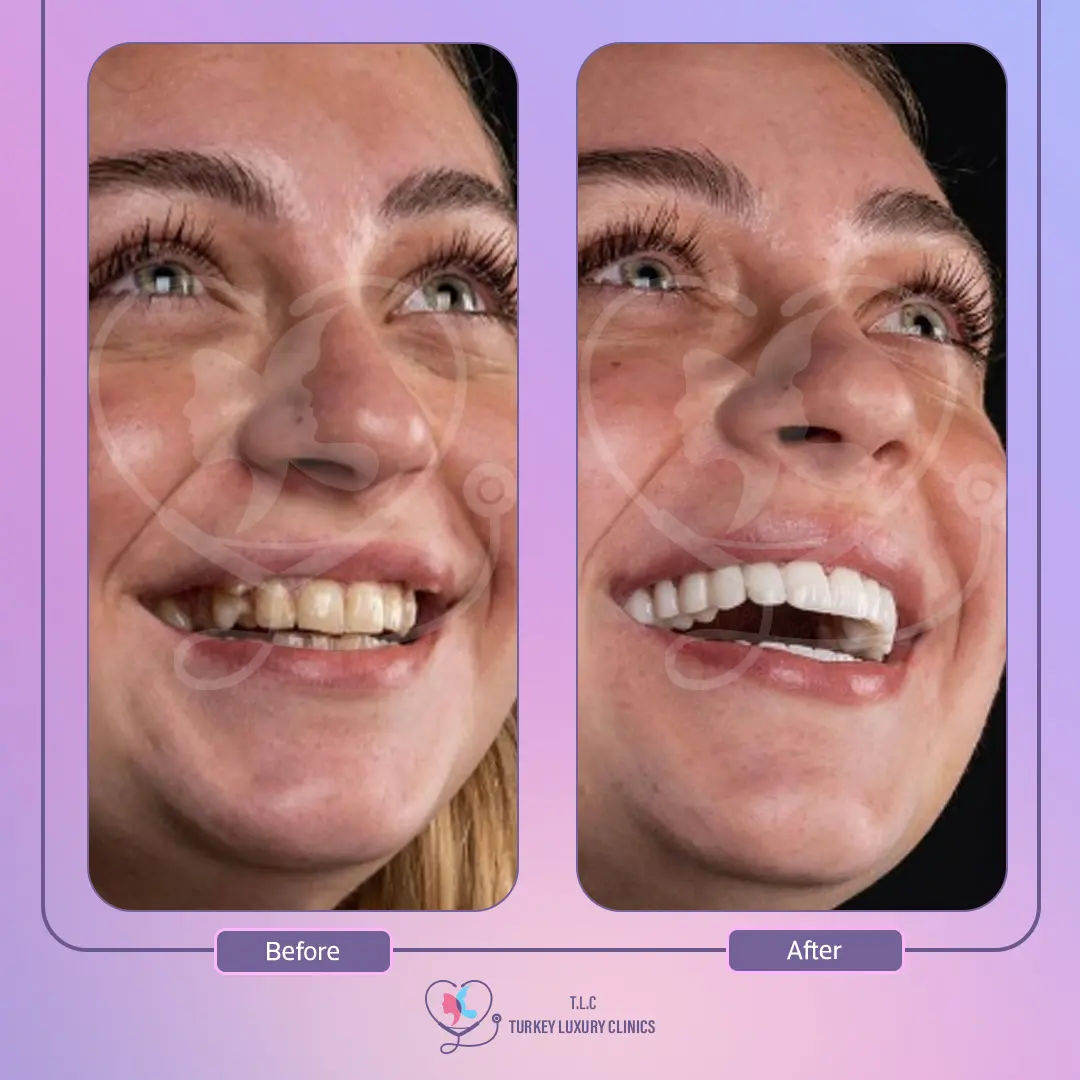 طريقة تركيب ابتسامة هوليود 3d