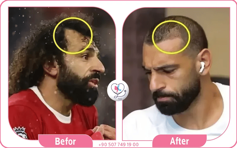 زراعة شعر محمد صلاح قبل وبعد بالصور زراعة شعر محمد صلاح قبل وبعد بالصور