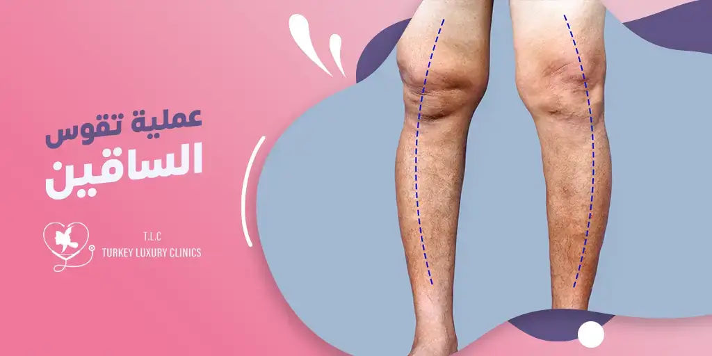 عملية تقوس الساقين في تركيا: الدليل الشامل