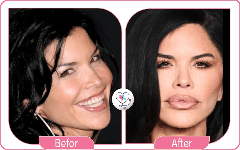 Lauren Sanchez Lips Before and After