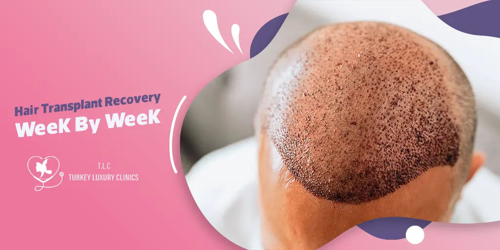 Haartransplantation Woche für Woche: Von Woche 1 bis 48