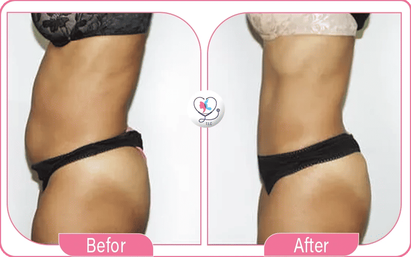 Stomach 360 lipo without tummy tuck before and after photos 3