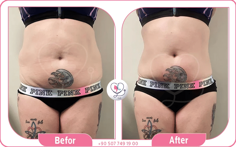 تجارب الناس مع ابر اوزمبك والوزن المفقود 