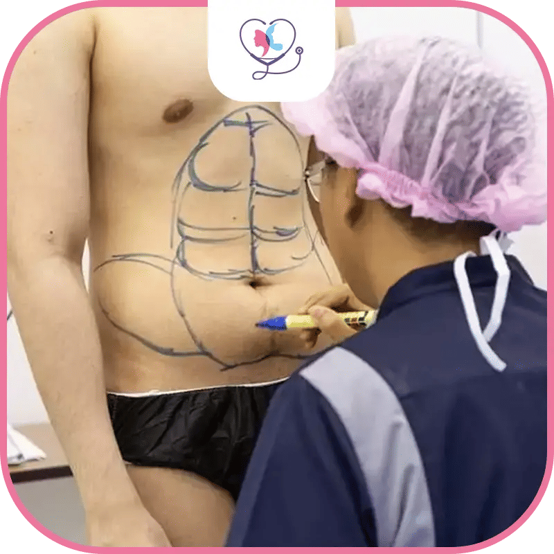 تكلفة عملية Six-Pack في تركيا: فهم التكاليف والمزايا