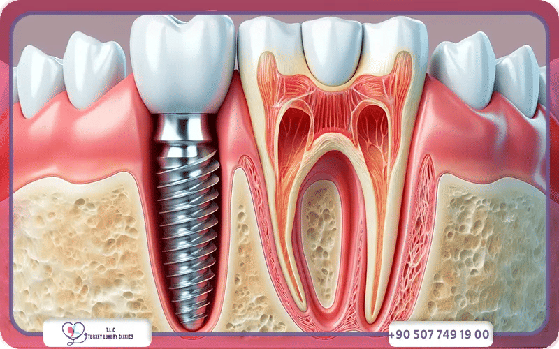 quel est le Prix moyen d’un implant dentaire en France
