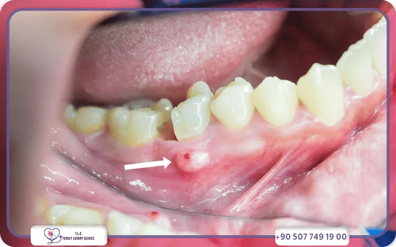 خراج الأسنان بالصور-2