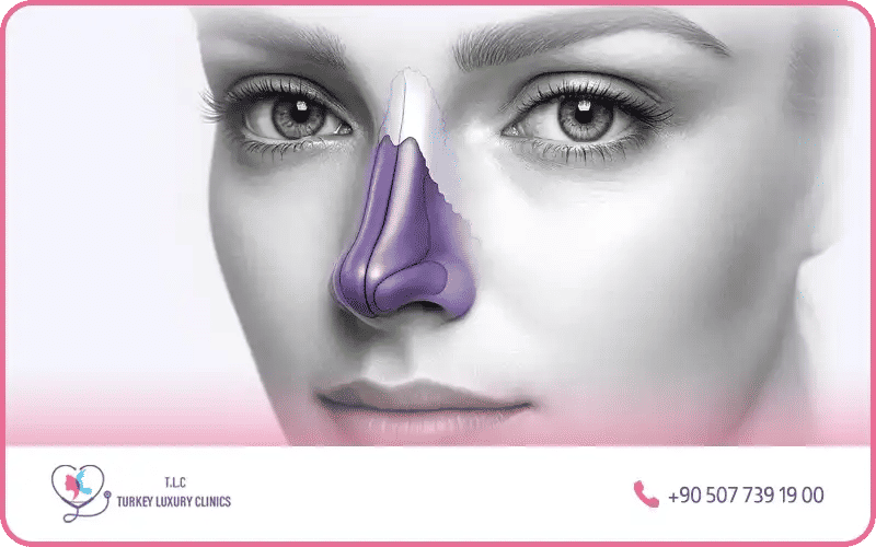 Évolution Avant Après la Rhinoplastie Ultrasonique