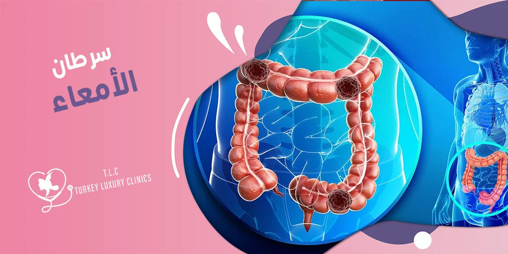 سرطان الأمعاء: الأعراض وطرق العلاج الفعالة والتكلفة