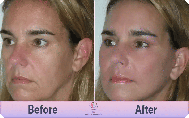 صور قبل وبعد أفضل عيادات شد الوجه في اسطنبول