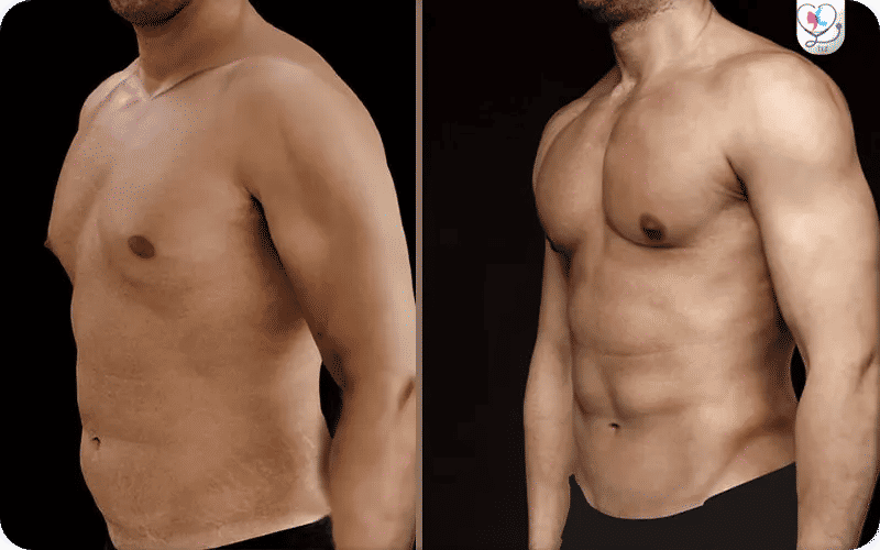 Liposuccion HD (Haute Définition)