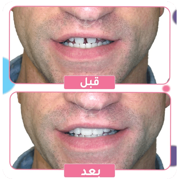 ابتسامة هوليود المتحركة
