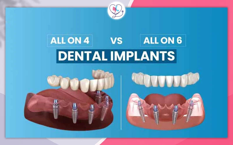 All-on-4 and All-on-6 Dental Implants for Diabetics