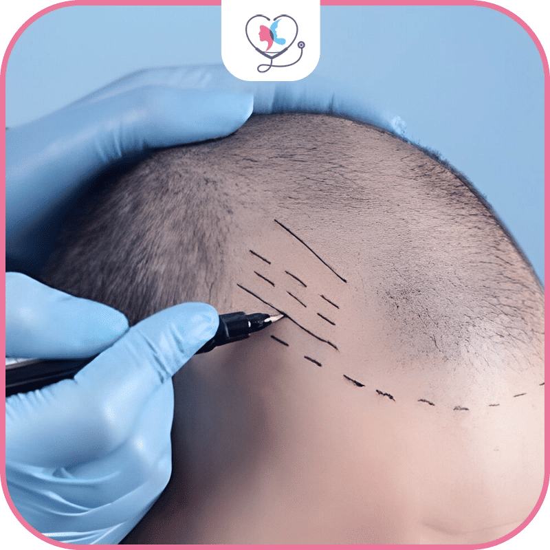 Benefits of Hair Transplant