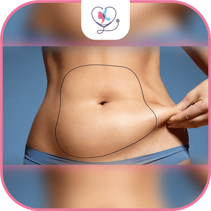 Quelle différence entre liposuccion et abdominoplastie ?