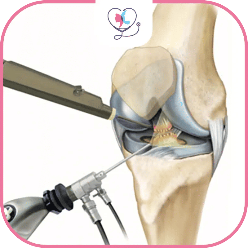 Minimally Invasive Knee Replacement Complications