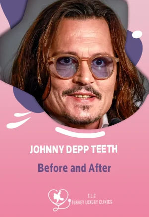 Johnny Depp Teeth Before and After: The Dramatic Smile Transformation Explained