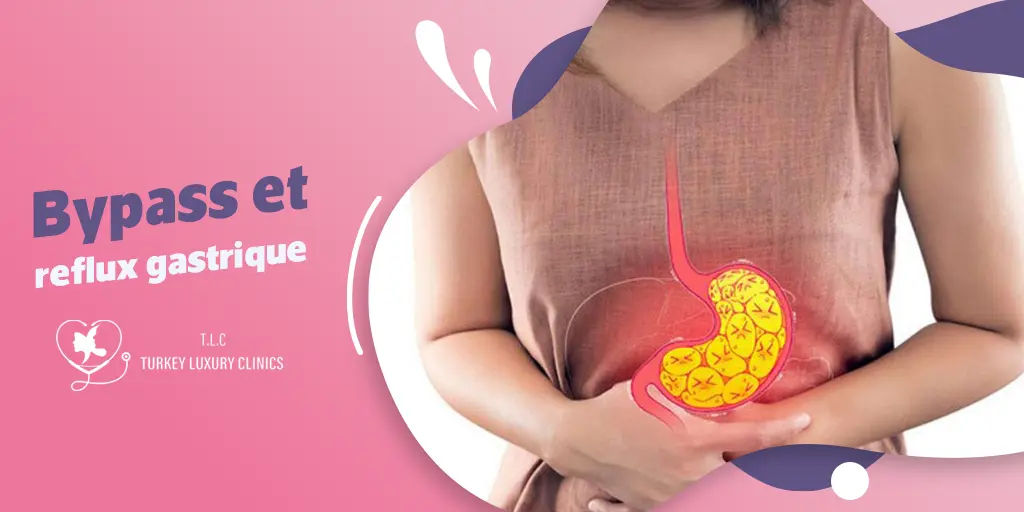 Bypass et reflux gastrique : Comprendre le lien et les solutions