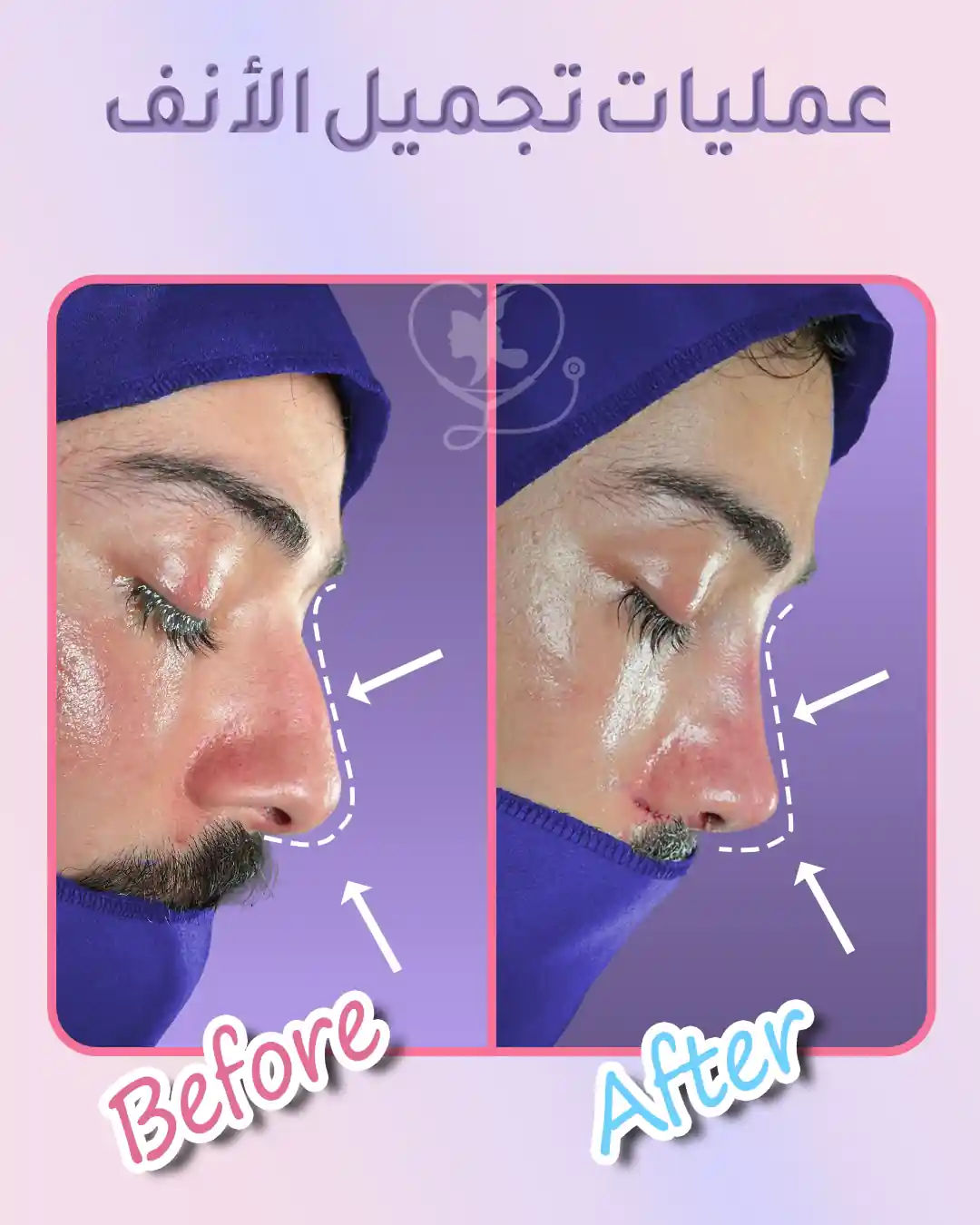 نتائج عملية تجميل الأنف