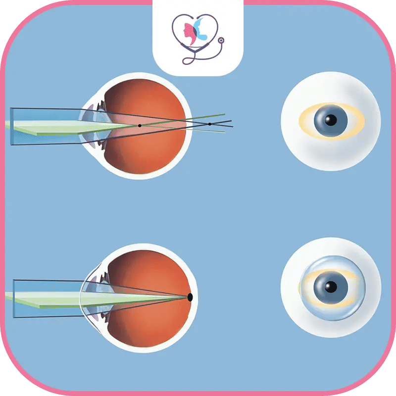 تصحيح النظر في تركيا