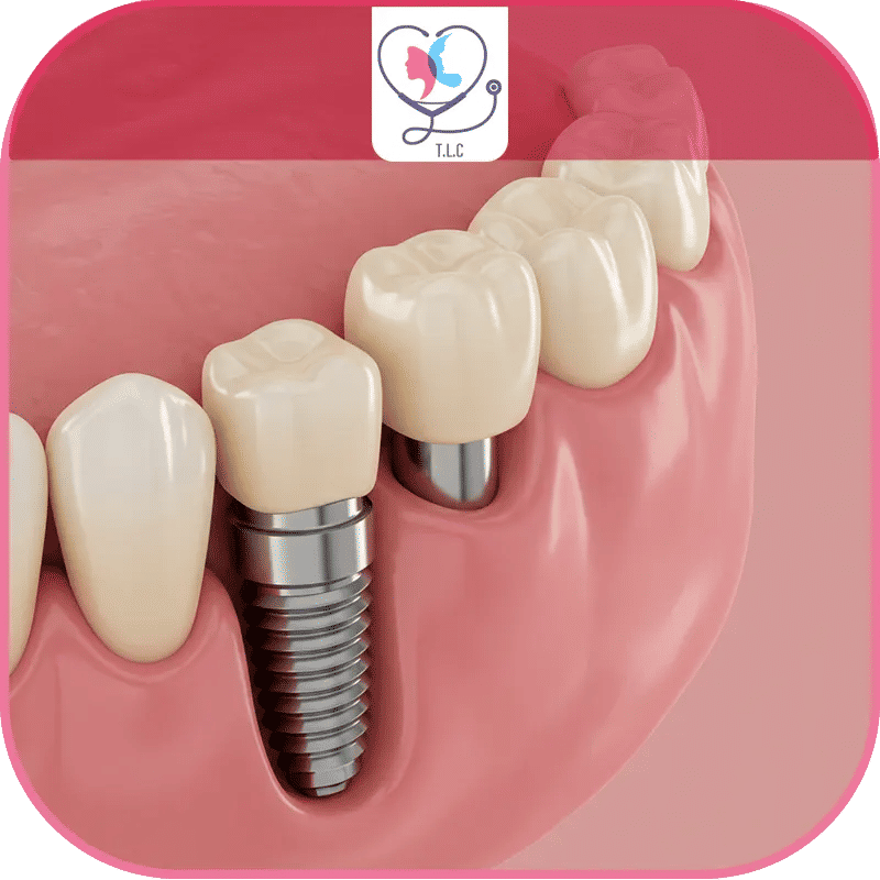 تجربتي مع زراعة الاسنان في تركيا-1772049316789