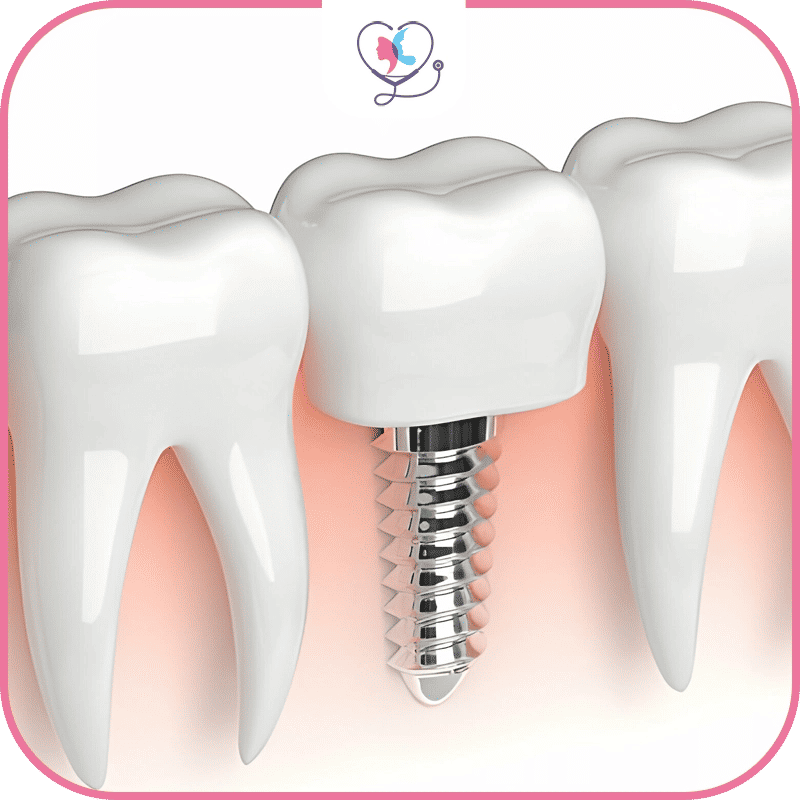 Qui est le candidat idéal à la pose d'implant dentaire le jour même
