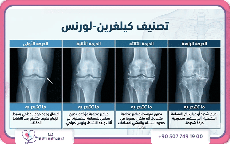 إليك في الجدول التالي مقارنة أهم الفروق في درجات خشونة الركبة بالصور: إليك في الجدول التالي مقارنة أهم الفروق في درجات خشونة الركبة بالصور: