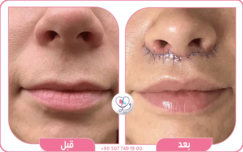  قرن الثور Bullhorn Lip Lift