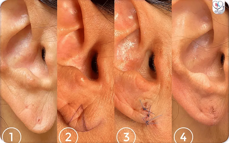 What is the Recovery Time for Otoplasty?