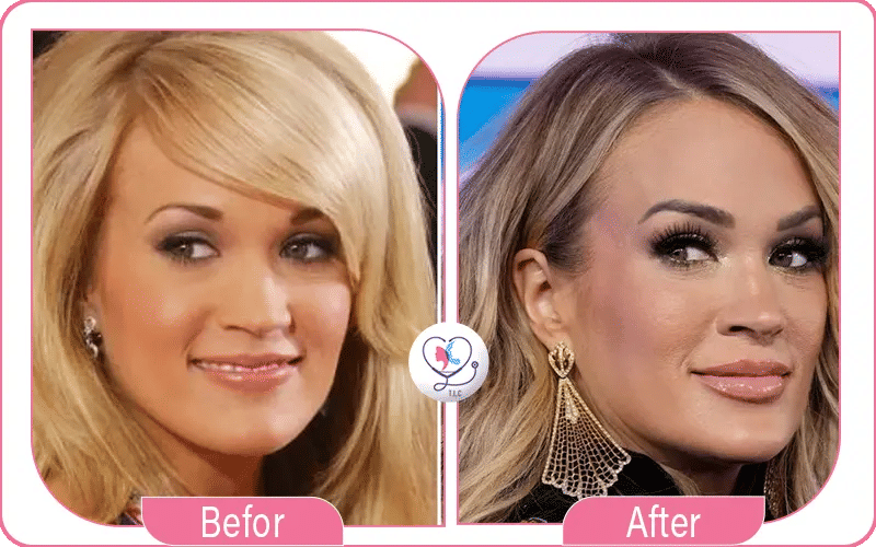 Carrie Underwood Plastic Surgery Lips