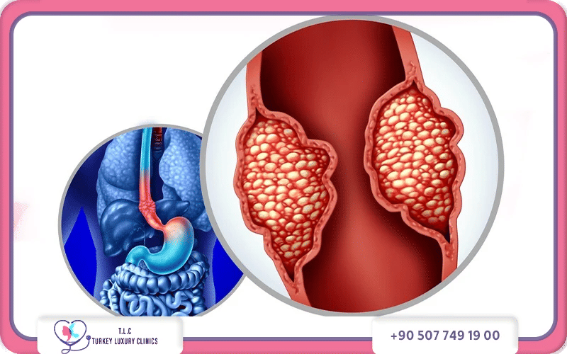 شكل سرطان المريء