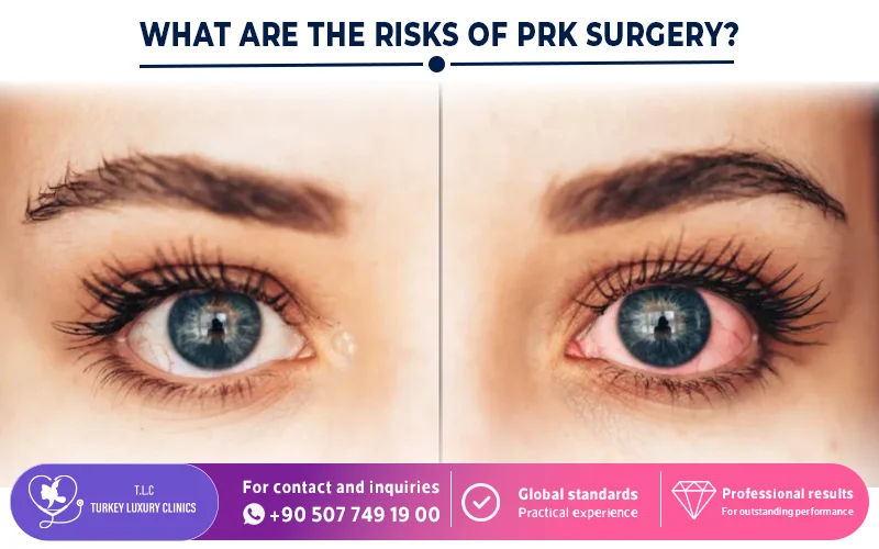 What Are the Risks of PRK Surgery?