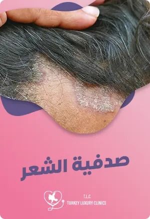 صدفية الشعر: أهم أعراضها وطرق علاجها للسيطرة على الحالةfeatured image