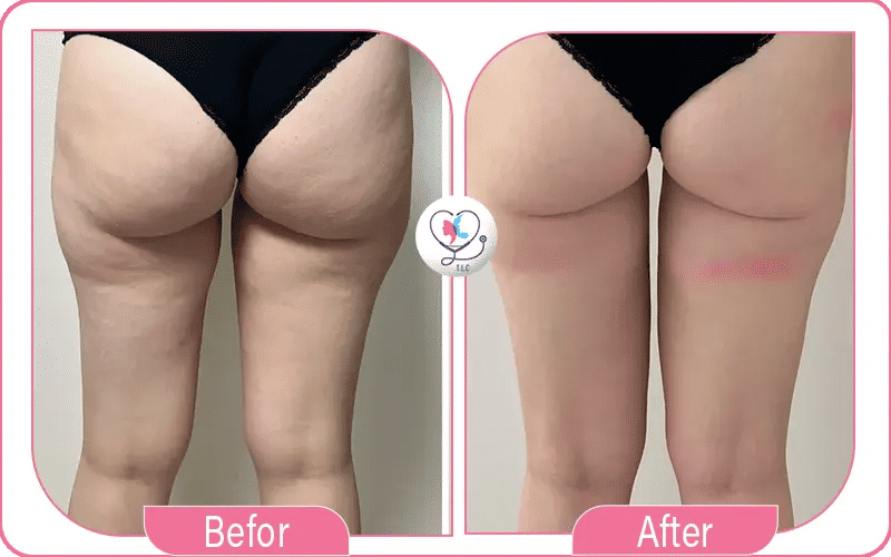 Photos avant / après liposuccion à 1 mois