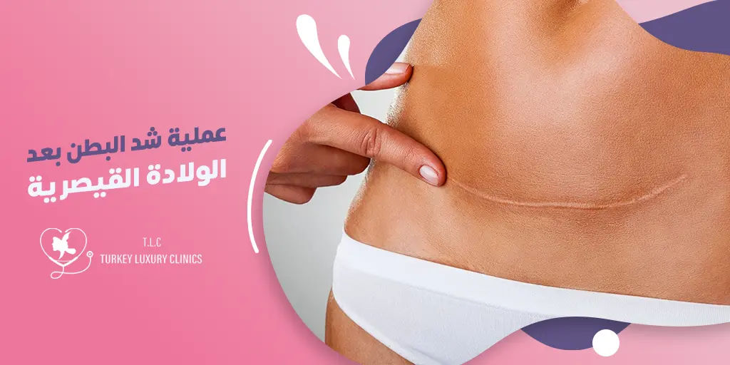 عملية شد البطن بعد الولادة القيصرية