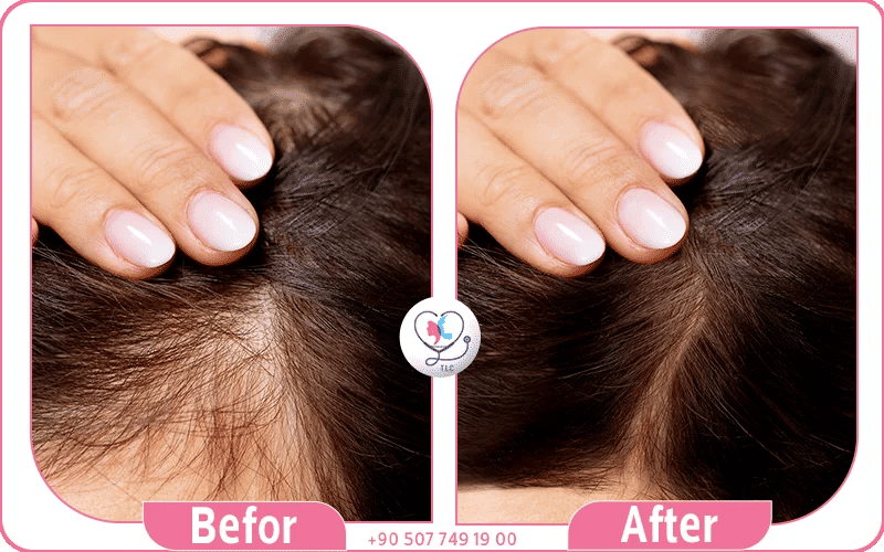 ثانياً: الطرق الدوائية لعلاج فراغات الشعر