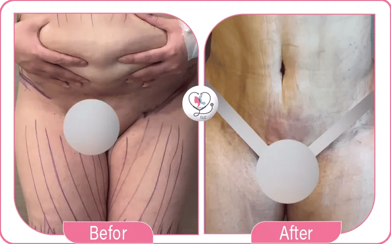 Photos avant / après liposuccion à 1 mois-2