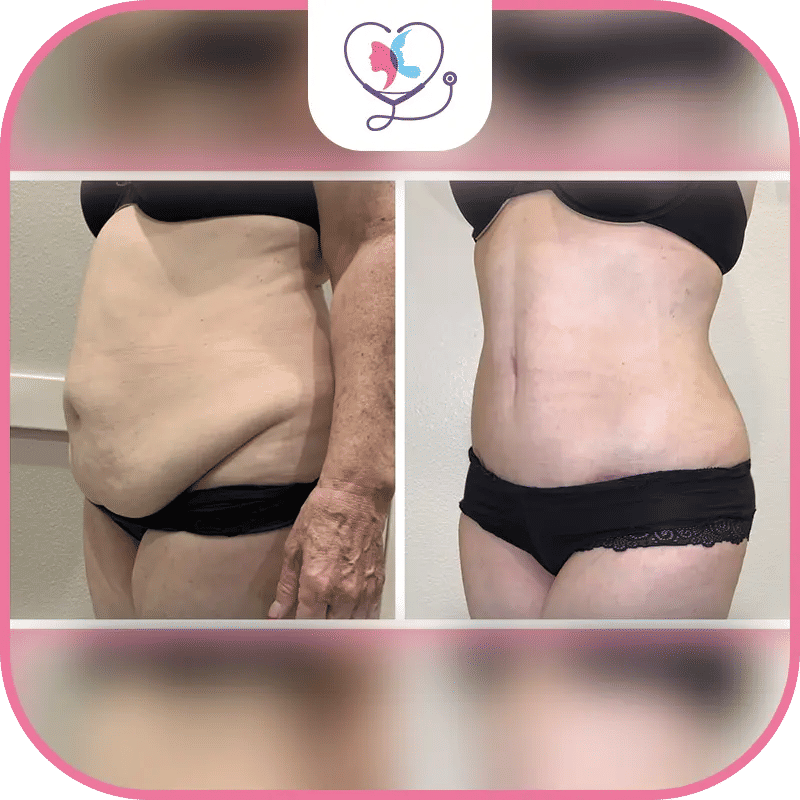 نتائج عملية شد البطن بالصور للنساء